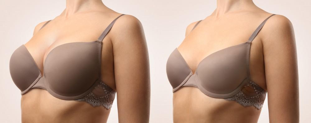 What is the difference between Breast Lift and Augmentation?